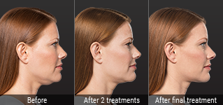 Three side profiles of a woman before and after Kybella treatment
