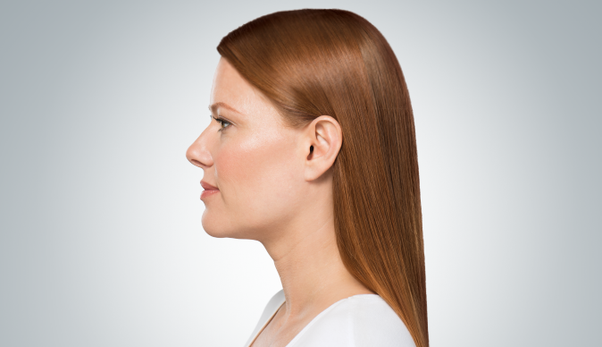 Side profile of a woman before Kybella treatment