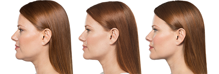 Zen Luxe Medspa KYBELLA® patients—and the results—speak for themselves.