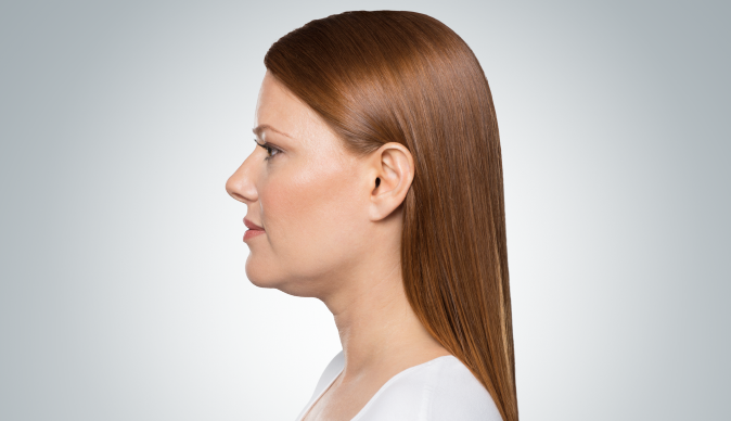 Side profile of a woman before Kybella treatment