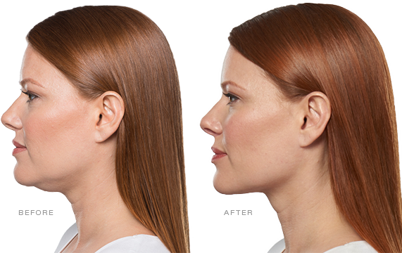 Kybella for a Chiseled Jawline, Utah Facial Plastics