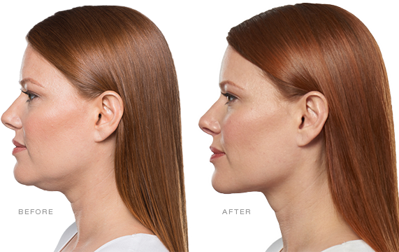 Two side profiles of a woman's face, before and after Kybella