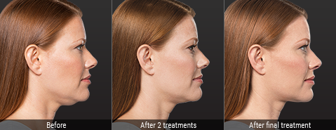 kybella-before-and-after