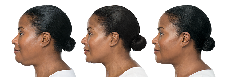 Zen Luxe Medspa KYBELLA® patients—and the results—speak for themselves.